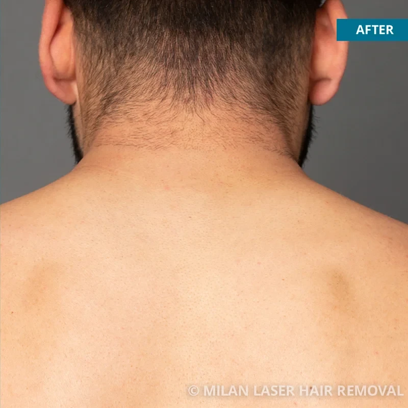 Men's Before & After Photos of Laser Hair Removal | Milan Laser in York, PA